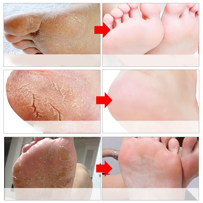 Feet Exfoliating Foot Masks Pe - Foot Mask Peeling recension och pris